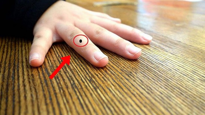 Có nên tẩy nốt ruồi không? Có nên tẩy nốt ruồi không?