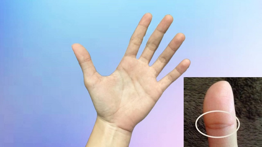 Nốt ruồi ngón tay cái Nốt ruồi ngón tay cái